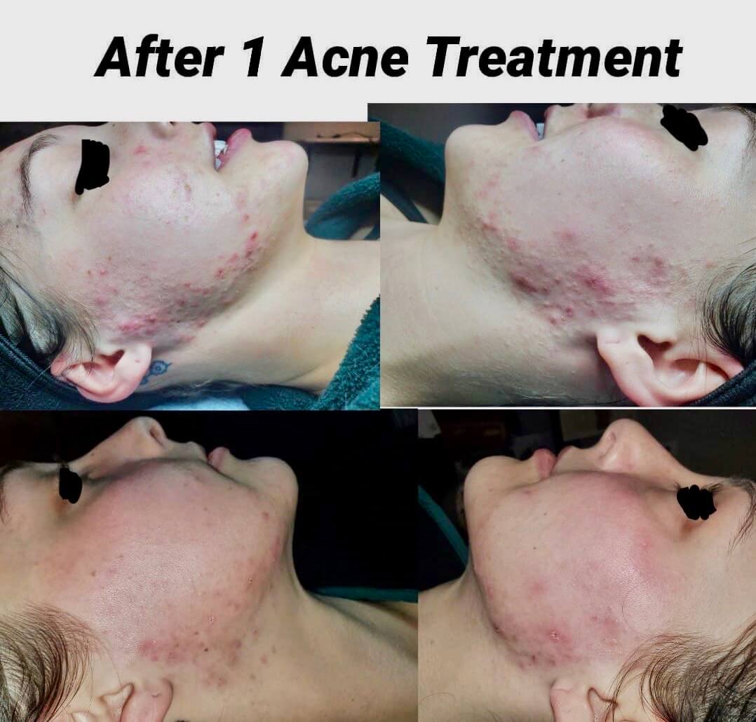 Men's skin, Men's skincare, men's hair loss, hair loss, men's facial, metrosexual, men's acne, nose wax, ear wax, mens waxing,, NC, SouthPark, Esthetician, Esthetics, Skincare, Facials, Treatments, Skin, Skin help, Anti-aging, Age management, wrinkle help, wrinkle treatment, Acne, Teen acne, Adult acne, clogged pores, Med-spa, Custom facial, Microneedling, Microchanneling, Waxing, Facial waxing, Corrective Skincare, Dermaplaning, Dermaplane, Plasma Fibroblast, Chemical peels, Face peels, LED therapy, LED facials, Skin resurfacing, Opti resurfacing, Beauty, Facial beauty, Facial hair, Botox, Fillers, Rosacea, Skin extractions, Oily skin help, Blackhead help, Woodlawn, Park Road, Park Rd, Park Road Shopping Center, Tyvola, I-485, South Charlotte, Eastover, Cotswold, Ballantyne, Dilworth, Southend, LoSo, Selwyn, Freedom Park, I-77, SouthPark mall, Salt room, Salt therapy, Reliable, Honest, Affordable, Quality, Responsible, Licensed, Certified, Dermatology, Dermatologist, Archdale, Noda, Uptown, Quail Hollow, Seven Eagles, Piedmont Row, Queen City, Carmel, Cysts, Cystic Acne, Pimple Popper, Pineville, South Blvd, Quail Corners, Recommended, Stonecrest, Steele Creek, Yorkmount, 5 stars, Aging, BBB, Belmont, Best, Best of, Better Business Bureau, Bonded, Business, Plant based, Natural, Caring, Calm, Carolina Mall, Budget, Concord, Huntersville, Five star, Friendly, Trustworthy, Help, Tips, Treatment, Laser, Inexpensive, Fair, Instagram, Joy, Mental Health, OCD, Dermatillomania, Luxury, Myers Park, Teen, Teenager, North Carolina, Over 40, Over 30, Over 50, Piper Glen, Price, Privacy, Pro, Professional, Raintree, Providence Plantation, Metropolitan, Providence Road, Toringdon, Carmel Commons, Trust, Training, Waverly, Weddington, Cosmetology, Waxing, Bikini Wax, Eyebrow Wax, Lip Wax, Face wax, Mask, Maskne, Backne, Cleanser, Toner, Cream, Retinol, Retinoid, Exfoliate, Exfoliater, Exfoliating, Massage, Hair removal, Products, 704, Charlotte Business, Clogged, Comedones, Nodules, Papules, Pustules, Acne Vulgaris, Fungal, Hyperpigmentation, Hypopigmentation, Excess oil, Dead skin, Texture, Brightening, Dark spots, Willmore, Sedgefield, Hormonal,