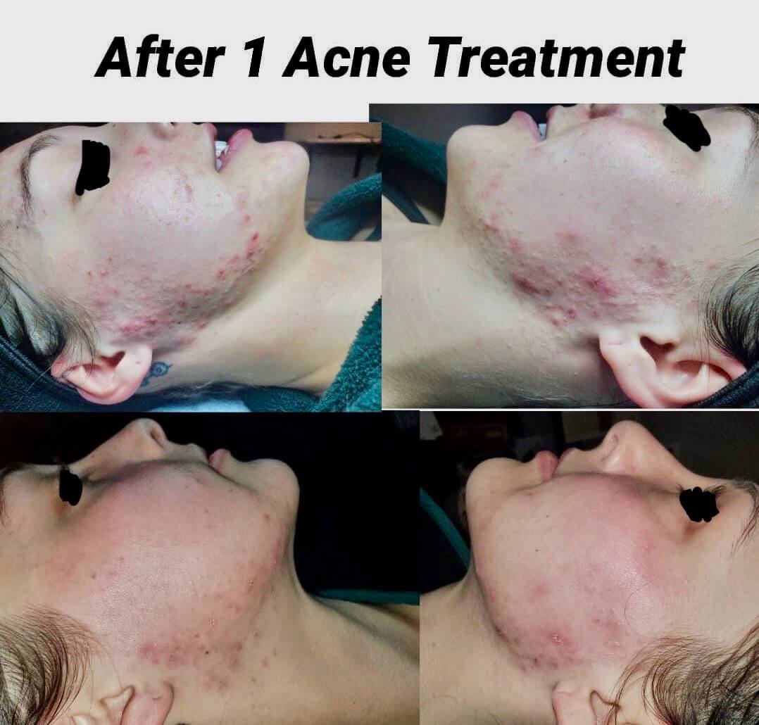 acne treatment in charlotte, nc Charlotte, NC, SouthPark, Esthetician, Esthetics, Skincare, Facials, Treatments, Skin, Skin help, Anti-aging, Age management, wrinkle help, wrinkle treatment, Acne, Teen acne, Adult acne, clogged pores, Med-spa, Custom facial, Microneedling, Microchanneling, Waxing, Facial waxing, Corrective Skincare, Dermaplaning, Dermaplane, Plasma Fibroblast, Chemical peels, Face peels, LED therapy, LED facials, Skin resurfacing, Opti resurfacing, Beauty, Facial beauty, Facial hair, Botox, Fillers, Rosacea, Skin extractions, Oily skin help, Blackhead help,