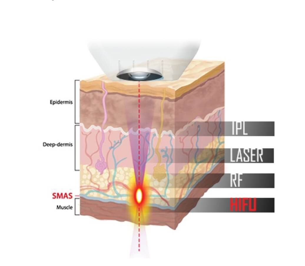 HIFU Charlotte, NC anti aging skin tightening