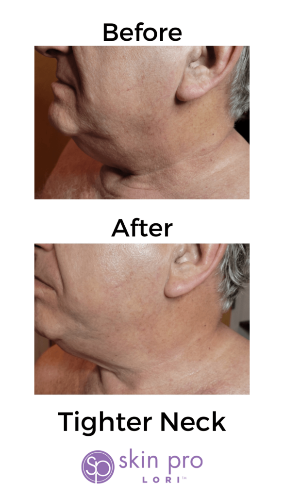 Charlotte, NC, SouthPark, Esthetician, Esthetics, Skincare, Facials, Treatments, Skin, Skin help, Anti-aging, Age management, wrinkle help, wrinkle treatment, Acne, Teen acne, Adult acne, clogged pores, Med-spa, Custom facial, Ultherapy, HIFU, Non surgical, Microneedling, Microchanneling, Waxing, Facial waxing, Corrective Skincare, Dermaplaning, Dermaplane, Plasma Fibroblast, Chemical peels, Face peels, LED therapy, LED facials, Skin resurfacing, Opti resurfacing, Beauty, Facial beauty, Facial hair, Botox, Fillers, Rosacea, Skin extractions, Oily skin help, Blackhead help, Woodlawn, Park Road, Park Rd, Park Road Shopping Center, Tyvola, I-485, South Charlotte, Eastover, Cotswold, Ballantyne, Dilworth, Southend, LoSo, Selwyn, Freedom Park, I-77, SouthPark mall, Salt room, Salt therapy, Reliable, Honest, Affordable, Quality, Responsible, Licensed, Certified, Dermatology, Dermatologist, Archdale, Noda, Uptown, Quail Hollow, Seven Eagles, Piedmont Row, Queen City, Carmel, Cysts, Cystic Acne, Pimple Popper, Pineville, South Blvd, Quail Corners, Recommended, Stonecrest, Steele Creek, Yorkmount, 5 stars, Aging, BBB, Belmont, Best, Best of, Better Business Bureau, Bonded, Business, Plant based, Natural, Caring, Calm, Carolina Mall, Budget, Concord, Huntersville, Five star, Friendly, Trustworthy, Help, Tips, Treatment, Laser, Inexpensive, Fair, Instagram, Joy, Mental Health, OCD, Dermatillomania, Luxury, Myers Park, Teen, Teenager, North Carolina, Over 40, Over 30, Over 50, Piper Glen, Price, Privacy, Pro, Professional, Raintree, Providence Plantation, Metropolitan, Providence Road, Toringdon, Carmel Commons, Trust, Training, Waverly, Weddington, Cosmetology, Waxing, Bikini Wax, Eyebrow Wax, Lip Wax, Face wax, Mask, Maskne, Backne, Cleanser, Toner, Cream, Retinol, Retinoid, Exfoliate, Exfoliater, Exfoliating, Massage, Hair removal, Products, 704, Charlotte Business, Clogged, Comedones, Nodules, Papules, Pustules, Acne Vulgaris, Fungal, Hyperpigmentation, Hypopigmentation, Excess oil, Dead skin, Texture, Brightening, Dark spots, Willmore, Sedgefield, Hormonal, Men's skin, Men's skincare, men's hair loss, hair loss, men's facial, metrosexual, men's acne, nose wax, ear wax, mens waxing,