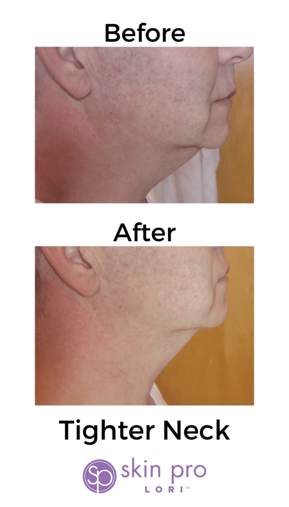 Charlotte, NC, SouthPark, Esthetician, Esthetics, Skincare, Facials, Treatments, Skin, Skin help, Anti-aging, Age management, wrinkle help, wrinkle treatment, Acne, Teen acne, Adult acne, clogged pores, Med-spa, Custom facial, Ultherapy, HIFU, Non surgical, Microneedling, Microchanneling, Waxing, Facial waxing, Corrective Skincare, Dermaplaning, Dermaplane, Plasma Fibroblast, Chemical peels, Face peels, LED therapy, LED facials, Skin resurfacing, Opti resurfacing, Beauty, Facial beauty, Facial hair, Botox, Fillers, Rosacea, Skin extractions, Oily skin help, Blackhead help, Woodlawn, Park Road, Park Rd, Park Road Shopping Center, Tyvola, I-485, South Charlotte, Eastover, Cotswold, Ballantyne, Dilworth, Southend, LoSo, Selwyn, Freedom Park, I-77, SouthPark mall, Salt room, Salt therapy, Reliable, Honest, Affordable, Quality, Responsible, Licensed, Certified, Dermatology, Dermatologist, Archdale, Noda, Uptown, Quail Hollow, Seven Eagles, Piedmont Row, Queen City, Carmel, Cysts, Cystic Acne, Pimple Popper, Pineville, South Blvd, Quail Corners, Recommended, Stonecrest, Steele Creek, Yorkmount, 5 stars, Aging, BBB, Belmont, Best, Best of, Better Business Bureau, Bonded, Business, Plant based, Natural, Caring, Calm, Carolina Mall, Budget, Concord, Huntersville, Five star, Friendly, Trustworthy, Help, Tips, Treatment, Laser, Inexpensive, Fair, Instagram, Joy, Mental Health, OCD, Dermatillomania, Luxury, Myers Park, Teen, Teenager, North Carolina, Over 40, Over 30, Over 50, Piper Glen, Price, Privacy, Pro, Professional, Raintree, Providence Plantation, Metropolitan, Providence Road, Toringdon, Carmel Commons, Trust, Training, Waverly, Weddington, Cosmetology, Waxing, Bikini Wax, Eyebrow Wax, Lip Wax, Face wax, Mask, Maskne, Backne, Cleanser, Toner, Cream, Retinol, Retinoid, Exfoliate, Exfoliater, Exfoliating, Massage, Hair removal, Products, 704, Charlotte Business, Clogged, Comedones, Nodules, Papules, Pustules, Acne Vulgaris, Fungal, Hyperpigmentation, Hypopigmentation, Excess oil, Dead skin, Texture, Brightening, Dark spots, Willmore, Sedgefield, Hormonal, Men's skin, Men's skincare, men's hair loss, hair loss, men's facial, metrosexual, men's acne, nose wax, ear wax, mens waxing,