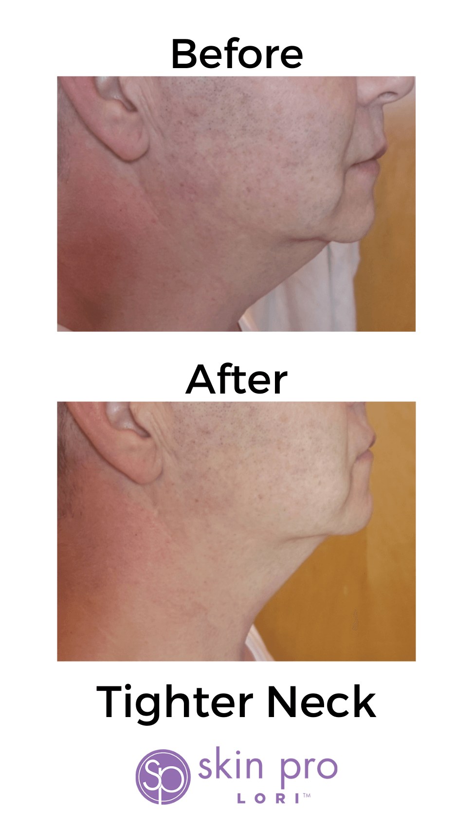 HIFU Charlotte, NC anti aging skin tightening