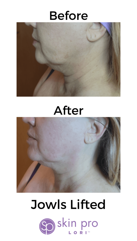 Charlotte, NC, SouthPark, Esthetician, Esthetics, Skincare, Facials, Treatments, Skin, Skin help, Anti-aging, Age management, wrinkle help, wrinkle treatment, Acne, Teen acne, Adult acne, clogged pores, Med-spa, Custom facial, Ultherapy, HIFU, Non surgical, Microneedling, Microchanneling, Waxing, Facial waxing, Corrective Skincare, Dermaplaning, Dermaplane, Plasma Fibroblast, Chemical peels, Face peels, LED therapy, LED facials, Skin resurfacing, Opti resurfacing, Beauty, Facial beauty, Facial hair, Botox, Fillers, Rosacea, Skin extractions, Oily skin help, Blackhead help, Woodlawn, Park Road, Park Rd, Park Road Shopping Center, Tyvola, I-485, South Charlotte, Eastover, Cotswold, Ballantyne, Dilworth, Southend, LoSo, Selwyn, Freedom Park, I-77, SouthPark mall, Salt room, Salt therapy, Reliable, Honest, Affordable, Quality, Responsible, Licensed, Certified, Dermatology, Dermatologist, Archdale, Noda, Uptown, Quail Hollow, Seven Eagles, Piedmont Row, Queen City, Carmel, Cysts, Cystic Acne, Pimple Popper, Pineville, South Blvd, Quail Corners, Recommended, Stonecrest, Steele Creek, Yorkmount, 5 stars, Aging, BBB, Belmont, Best, Best of, Better Business Bureau, Bonded, Business, Plant based, Natural, Caring, Calm, Carolina Mall, Budget, Concord, Huntersville, Five star, Friendly, Trustworthy, Help, Tips, Treatment, Laser, Inexpensive, Fair, Instagram, Joy, Mental Health, OCD, Dermatillomania, Luxury, Myers Park, Teen, Teenager, North Carolina, Over 40, Over 30, Over 50, Piper Glen, Price, Privacy, Pro, Professional, Raintree, Providence Plantation, Metropolitan, Providence Road, Toringdon, Carmel Commons, Trust, Training, Waverly, Weddington, Cosmetology, Waxing, Bikini Wax, Eyebrow Wax, Lip Wax, Face wax, Mask, Maskne, Backne, Cleanser, Toner, Cream, Retinol, Retinoid, Exfoliate, Exfoliater, Exfoliating, Massage, Hair removal, Products, 704, Charlotte Business, Clogged, Comedones, Nodules, Papules, Pustules, Acne Vulgaris, Fungal, Hyperpigmentation, Hypopigmentation, Excess oil, Dead skin, Texture, Brightening, Dark spots, Willmore, Sedgefield, Hormonal, Men's skin, Men's skincare, men's hair loss, hair loss, men's facial, metrosexual, men's acne, nose wax, ear wax, mens waxing,