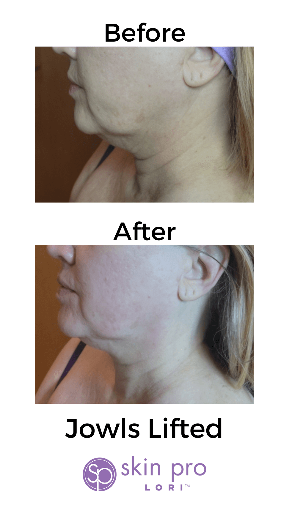 HIFU Charlotte, NC anti aging skin tightening