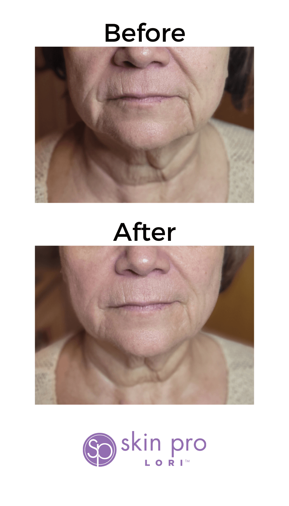 HIFU Charlotte, NC anti aging skin tightening