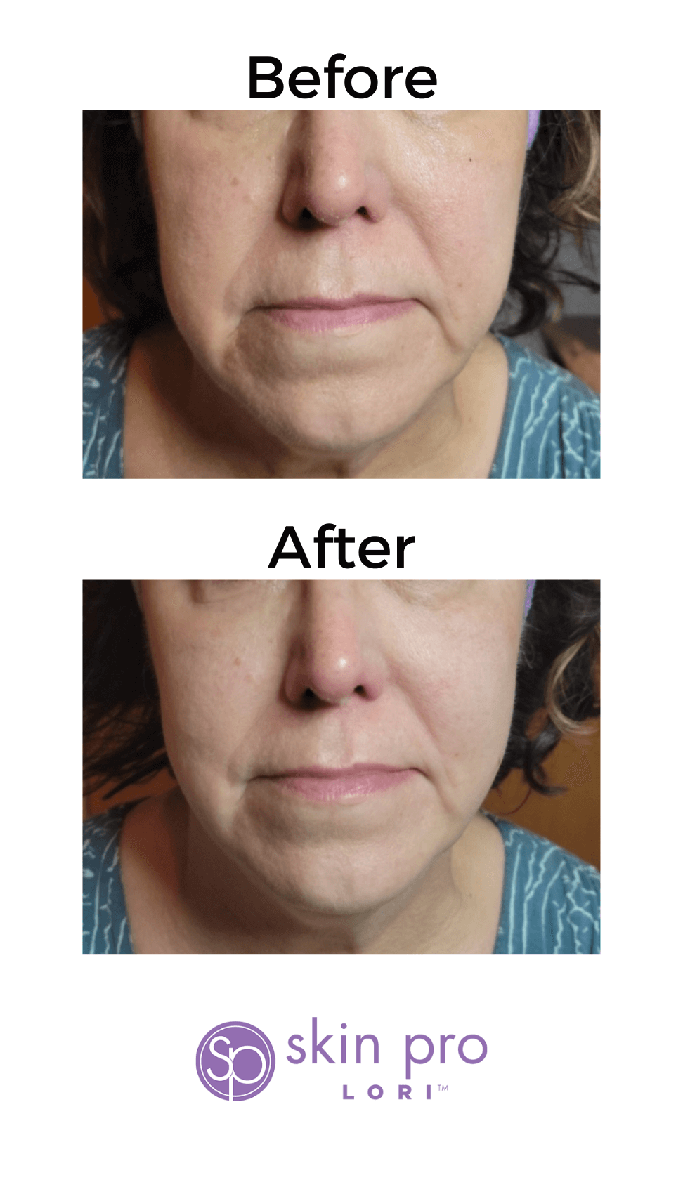 HIFU Charlotte, NC anti aging skin tightening