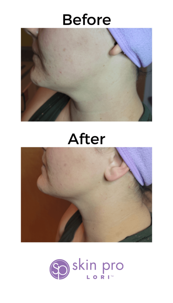 Charlotte, NC, SouthPark, Esthetician, Esthetics, Skincare, Facials, Treatments, Skin, Skin help, Anti-aging, Age management, wrinkle help, wrinkle treatment, Acne, Teen acne, Adult acne, clogged pores, Med-spa, Custom facial, Ultherapy, HIFU, Non surgical, Microneedling, Microchanneling, Waxing, Facial waxing, Corrective Skincare, Dermaplaning, Dermaplane, Plasma Fibroblast, Chemical peels, Face peels, LED therapy, LED facials, Skin resurfacing, Opti resurfacing, Beauty, Facial beauty, Facial hair, Botox, Fillers, Rosacea, Skin extractions, Oily skin help, Blackhead help, Woodlawn, Park Road, Park Rd, Park Road Shopping Center, Tyvola, I-485, South Charlotte, Eastover, Cotswold, Ballantyne, Dilworth, Southend, LoSo, Selwyn, Freedom Park, I-77, SouthPark mall, Salt room, Salt therapy, Reliable, Honest, Affordable, Quality, Responsible, Licensed, Certified, Dermatology, Dermatologist, Archdale, Noda, Uptown, Quail Hollow, Seven Eagles, Piedmont Row, Queen City, Carmel, Cysts, Cystic Acne, Pimple Popper, Pineville, South Blvd, Quail Corners, Recommended, Stonecrest, Steele Creek, Yorkmount, 5 stars, Aging, BBB, Belmont, Best, Best of, Better Business Bureau, Bonded, Business, Plant based, Natural, Caring, Calm, Carolina Mall, Budget, Concord, Huntersville, Five star, Friendly, Trustworthy, Help, Tips, Treatment, Laser, Inexpensive, Fair, Instagram, Joy, Mental Health, OCD, Dermatillomania, Luxury, Myers Park, Teen, Teenager, North Carolina, Over 40, Over 30, Over 50, Piper Glen, Price, Privacy, Pro, Professional, Raintree, Providence Plantation, Metropolitan, Providence Road, Toringdon, Carmel Commons, Trust, Training, Waverly, Weddington, Cosmetology, Waxing, Bikini Wax, Eyebrow Wax, Lip Wax, Face wax, Mask, Maskne, Backne, Cleanser, Toner, Cream, Retinol, Retinoid, Exfoliate, Exfoliater, Exfoliating, Massage, Hair removal, Products, 704, Charlotte Business, Clogged, Comedones, Nodules, Papules, Pustules, Acne Vulgaris, Fungal, Hyperpigmentation, Hypopigmentation, Excess oil, Dead skin, Texture, Brightening, Dark spots, Willmore, Sedgefield, Hormonal, Men's skin, Men's skincare, men's hair loss, hair loss, men's facial, metrosexual, men's acne, nose wax, ear wax, mens waxing,