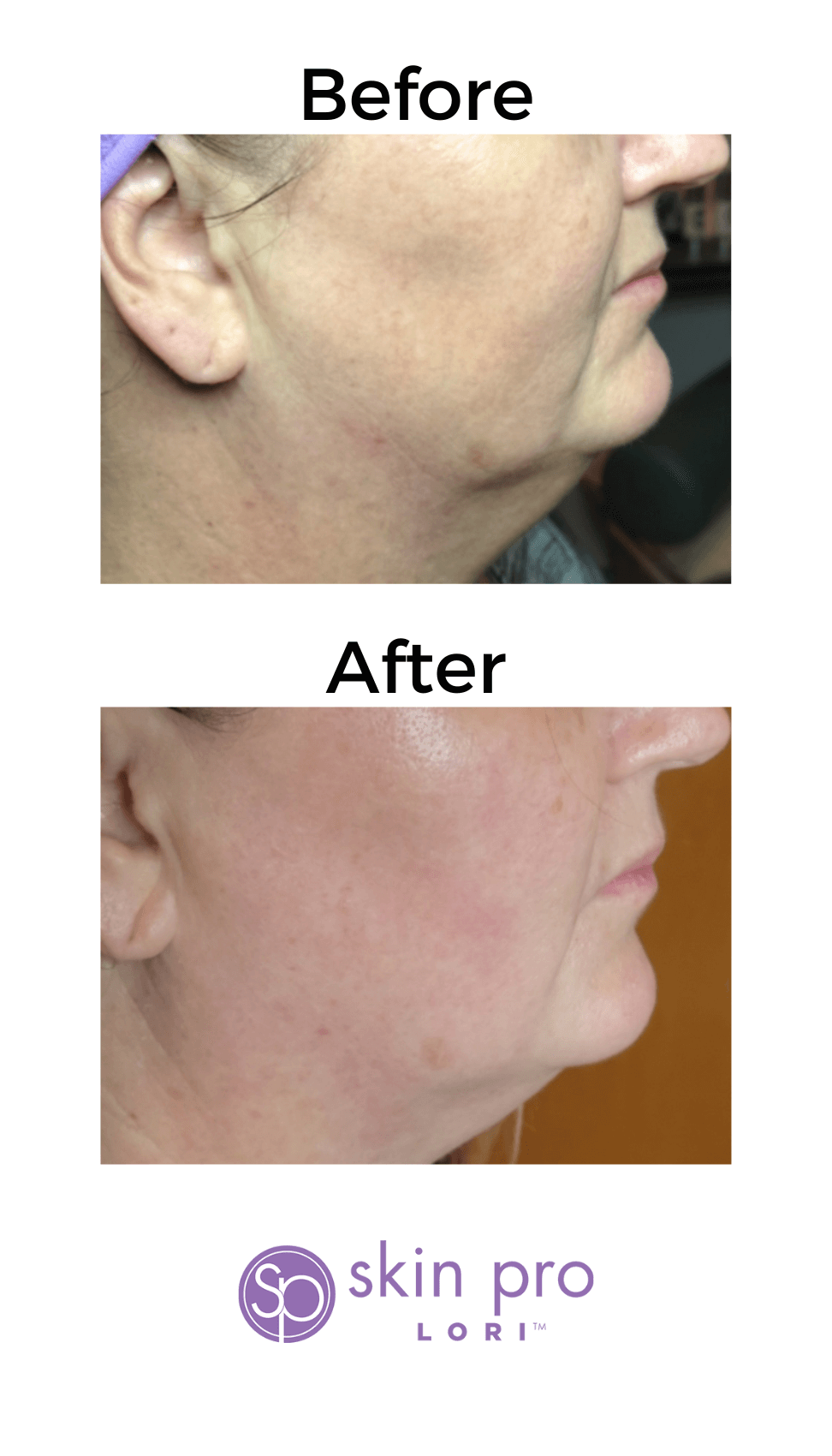 HIFU Charlotte, NC anti aging skin tightening