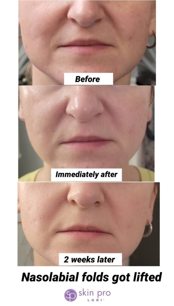 Charlotte, NC, SouthPark, Esthetician, Esthetics, Skincare, Facials, Treatments, Skin, Skin help, Anti-aging, Age management, wrinkle help, wrinkle treatment, Acne, Teen acne, Adult acne, clogged pores, Med-spa, Custom facial, Ultherapy, HIFU, Non surgical, Microneedling, Microchanneling, Waxing, Facial waxing, Corrective Skincare, Dermaplaning, Dermaplane, Plasma Fibroblast, Chemical peels, Face peels, LED therapy, LED facials, Skin resurfacing, Opti resurfacing, Beauty, Facial beauty, Facial hair, Botox, Fillers, Rosacea, Skin extractions, Oily skin help, Blackhead help, Woodlawn, Park Road, Park Rd, Park Road Shopping Center, Tyvola, I-485, South Charlotte, Eastover, Cotswold, Ballantyne, Dilworth, Southend, LoSo, Selwyn, Freedom Park, I-77, SouthPark mall, Salt room, Salt therapy, Reliable, Honest, Affordable, Quality, Responsible, Licensed, Certified, Dermatology, Dermatologist, Archdale, Noda, Uptown, Quail Hollow, Seven Eagles, Piedmont Row, Queen City, Carmel, Cysts, Cystic Acne, Pimple Popper, Pineville, South Blvd, Quail Corners, Recommended, Stonecrest, Steele Creek, Yorkmount, 5 stars, Aging, BBB, Belmont, Best, Best of, Better Business Bureau, Bonded, Business, Plant based, Natural, Caring, Calm, Carolina Mall, Budget, Concord, Huntersville, Five star, Friendly, Trustworthy, Help, Tips, Treatment, Laser, Inexpensive, Fair, Instagram, Joy, Mental Health, OCD, Dermatillomania, Luxury, Myers Park, Teen, Teenager, North Carolina, Over 40, Over 30, Over 50, Piper Glen, Price, Privacy, Pro, Professional, Raintree, Providence Plantation, Metropolitan, Providence Road, Toringdon, Carmel Commons, Trust, Training, Waverly, Weddington, Cosmetology, Waxing, Bikini Wax, Eyebrow Wax, Lip Wax, Face wax, Mask, Maskne, Backne, Cleanser, Toner, Cream, Retinol, Retinoid, Exfoliate, Exfoliater, Exfoliating, Massage, Hair removal, Products, 704, Charlotte Business, Clogged, Comedones, Nodules, Papules, Pustules, Acne Vulgaris, Fungal, Hyperpigmentation, Hypopigmentation, Excess oil, Dead skin, Texture, Brightening, Dark spots, Willmore, Sedgefield, Hormonal, Men's skin, Men's skincare, men's hair loss, hair loss, men's facial, metrosexual, men's acne, nose wax, ear wax, mens waxing,