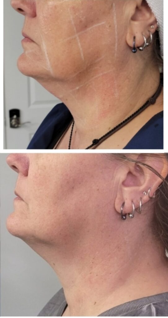 anti-aging treatment Charlotte NC