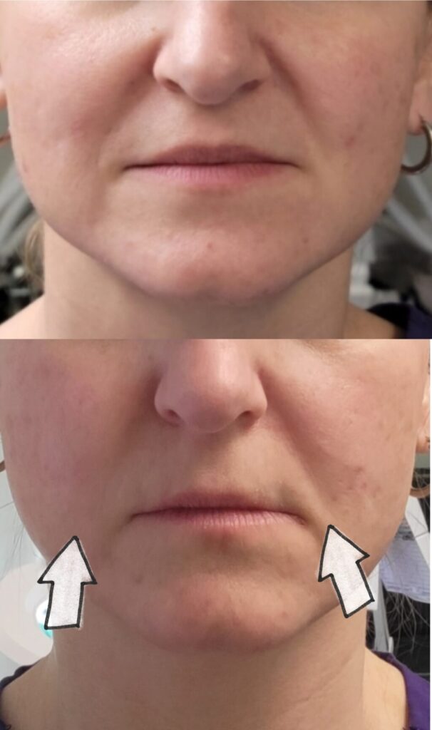 HIFU Skin charlotte nc lori hulshof