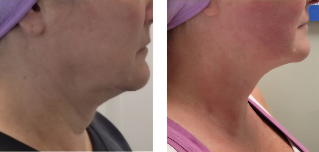 DualHi+ Hifu collagen building and lifting for months