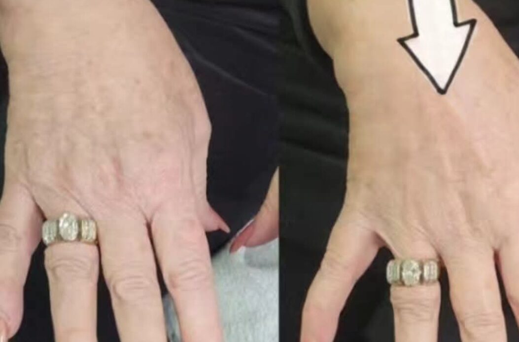DualHi+ Hifu treating wrinkles on hands