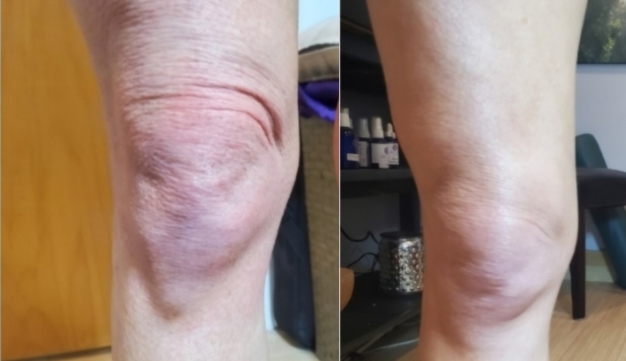 DualHi+ Hifu knee lifting and anti-aging