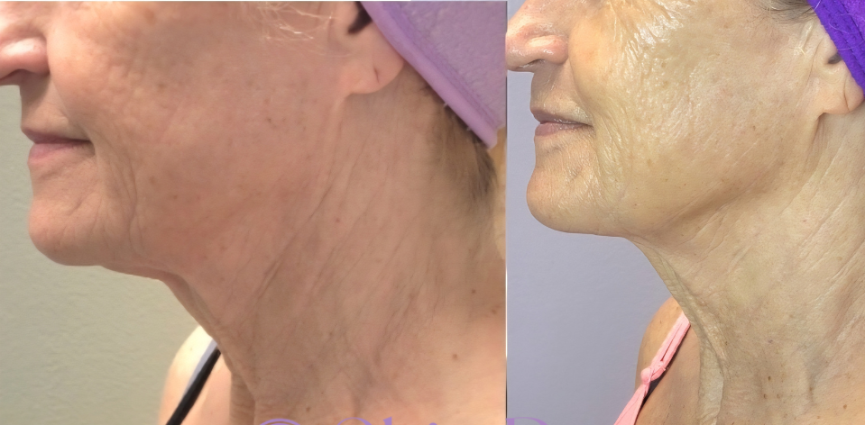 DualHi+ Hifu defining jawline