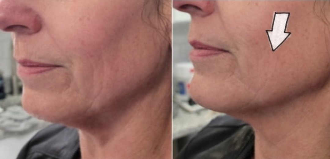DualHi+ Hifu face tightening