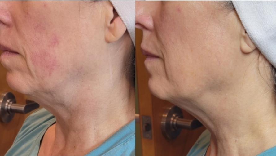 DualHi+ Hifu jaw definition enhanced
