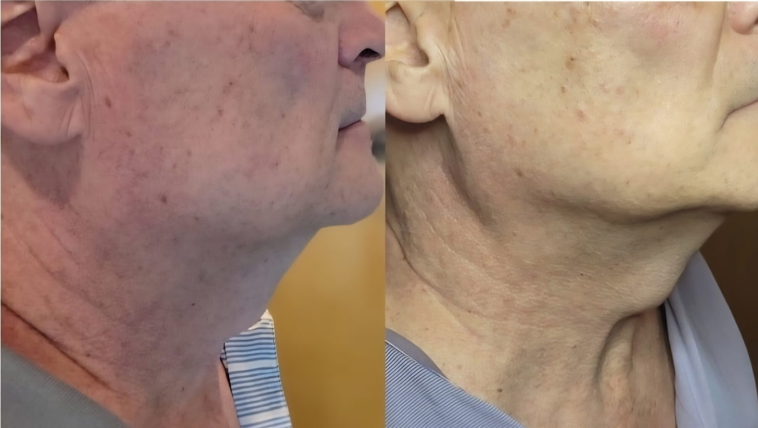 DualHi+ Hifu neck treatments for men