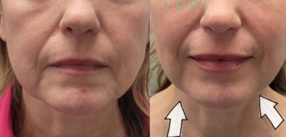 DualHi+ Hifu anti-aging, lifting face
