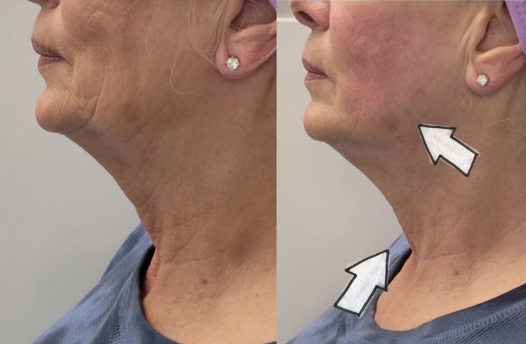 DualHi+ Hifu lifting of neck and defining jaw