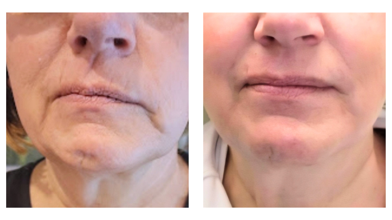 dualhi+ hifu anti-aging, wrinkle treatment in Charlotte, nc