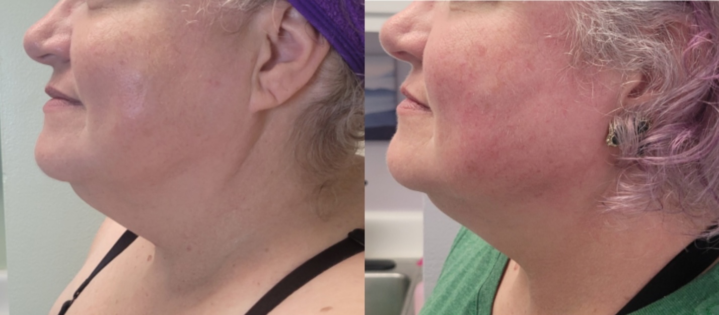 dualhi+ hifu anti-aging, wrinkle treatment in Charlotte, nc