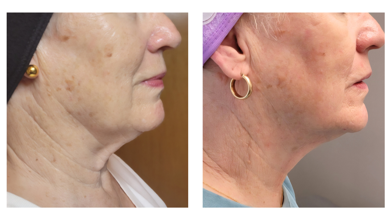 dualhi+ hifu anti-aging, neck treatment in Charlotte, nc