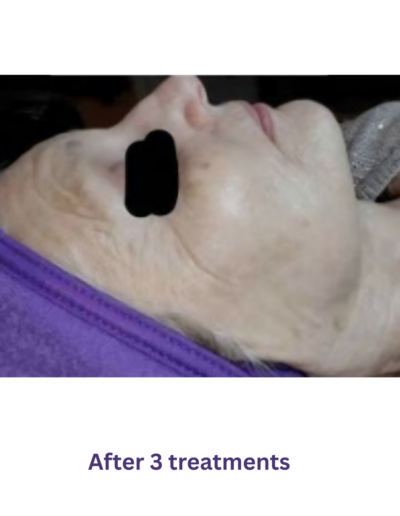 Microchanneling treating wrinkles in Waxhaw, NC