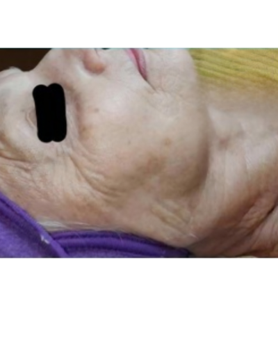 Microchanneling by Skin Pro Lori