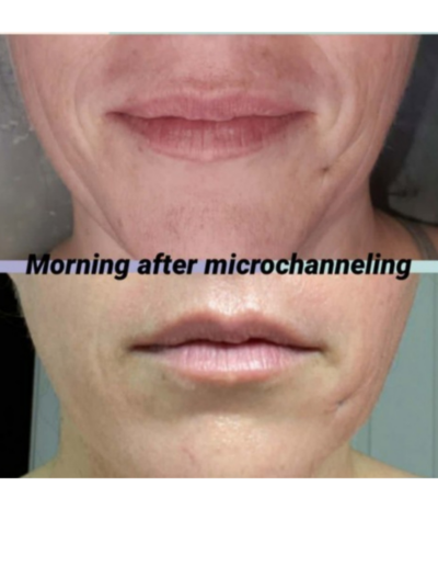 Microchanneling rejuvenates the skin and is more precise than micro needling