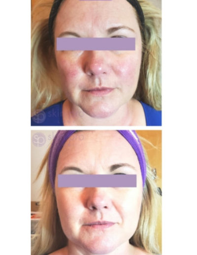 Microchanneling treats redness in skin