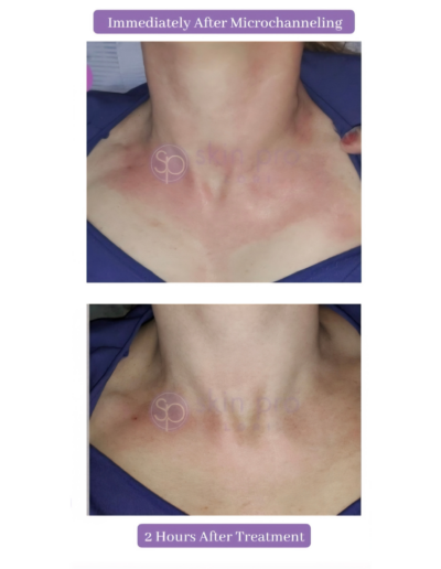 Microchanneling on neck in Charlotte, NC