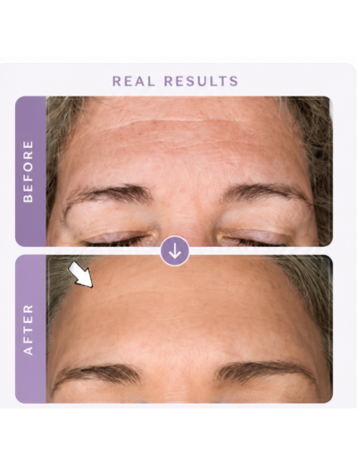 Microchanneling on Forehead by Skin Pro Lori in Matthews, NC