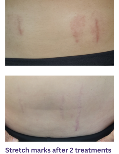 Microchanneling on scars in Dilworth